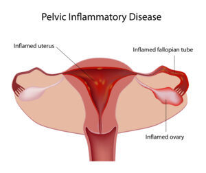 pelvic inflammatory disease as a result of untreated gonorrhea