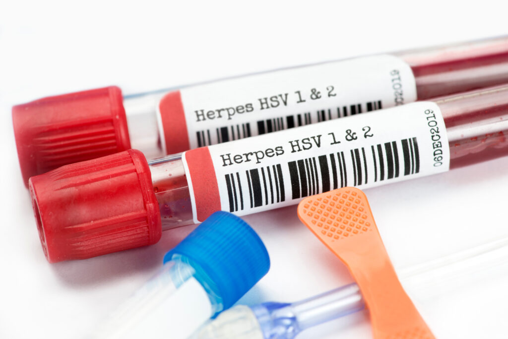 Herpes blood test